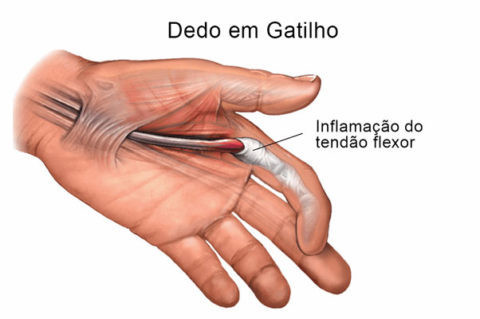A imagem se trata de uma representação gráfica de um paciente com dedo em gatilho.