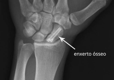 Enxerto ósseo | Dr. Fernando Moya