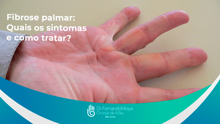 A imagem mostra a palma de uma mão com fibromatose.