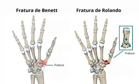 A imagem mostra os dois tipos de fraturas mais comuns. A de Benett e a de Rolando.