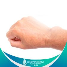 Patologia Tumores na Mão | Fernando Moya