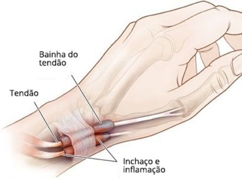Representação gráfica ilustrando tendões na região das mãos.