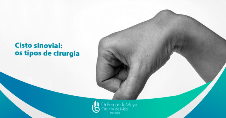 Cisto Sinovial Os Tipos De Cirurgia Dr Fernando Moya Crm