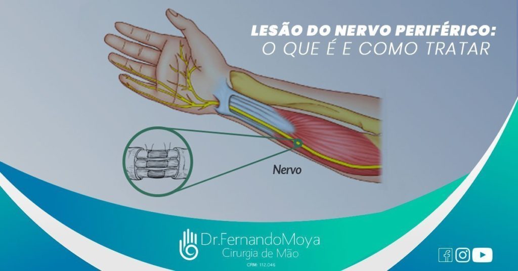 Ao fundo da imagem, há a representação de um braço com todos os tendões e nervos à mostra.